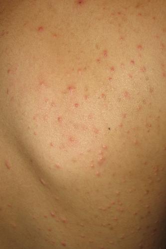 skin rash - picture of my son's skin rash