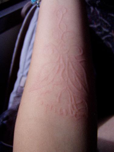 Dermatographia - My arm with a picture drawn by a friend of mine.