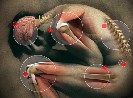 Pain Map - Chronic Pain map