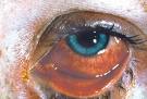 pink eye - this is a pic of somone with pink eye. pink eye - this is a pic of somone with pink eye.