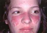 Lupus - This is a butterfly rash of Lupus because it goes across the nose to both cheeks.