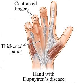 Dupuytren's Contracture - This is what I have on the tendon of my middle finger, almost in the middle of my palm. It hurts when pressure is applied. So far, it hasn't contracted my finger but the doc says it will, eventually.