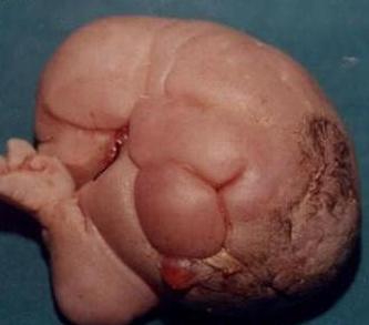 fetus en fetu - A condition called fetus en fetu, occurs when a twin is born with another twin growing inside him or her. Some of these people can live all their lives with out realizing they have remnants of unformed twins inside of them. The lesser twin is most often brainless.