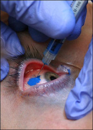 corneal tattooing - tattoo