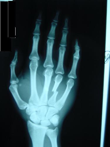 Broken Hands Roentgen - Broken left hands roentgen made in X-ray room. After the roentgen t got covered in gypsum.