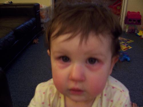 Poorly Becca - My youngest daughter when she had her bad eyes