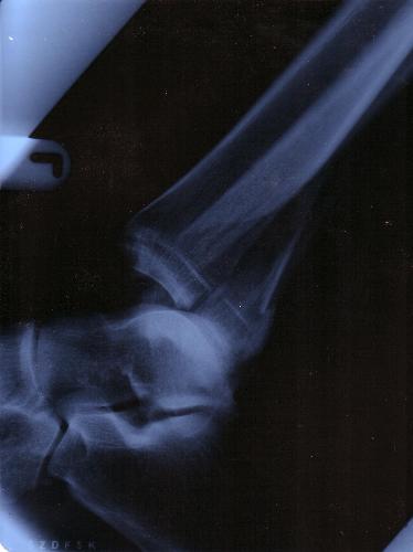 scan of broken left leg - jet skiing incident that left me with a broken left leg.