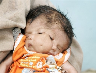 birth defects - two face baby birth defects - two face baby