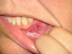 mouth sore  - avoid stressful things