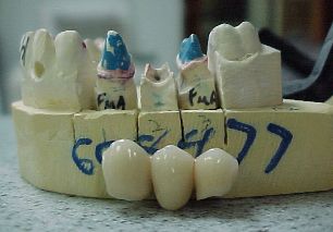 fixed bridge denture - its 1 of our patients when i was working in a dental clinic. its a fixed bridge denture