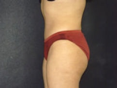Buttocks Inplants - Enlarged Butts