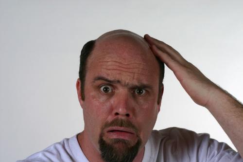 hair loss - hair loss in men