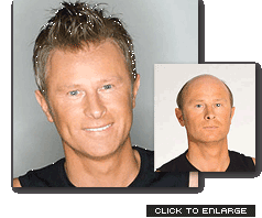 hair loss  - hair losses