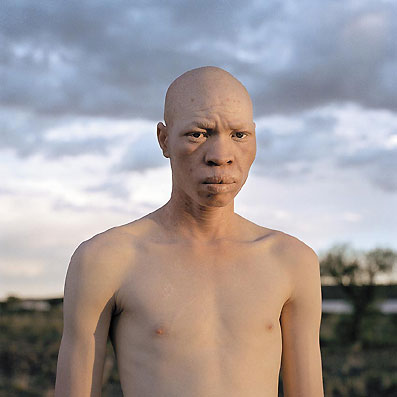 Tanzanian Albino - Tanzanian Albino in Fear