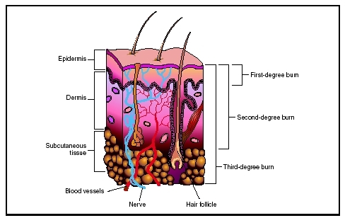 These are three classifications of burns - Hi friends,
there are 3 classification of burn
1. A first degree burn causes redness and swelling in the outermost layers of the skin.
2. A second degree burn involves redness, swelling, and blistering. The damage may extend to deeper layers of the skin
3. A third degree burn destroys the entire depth of the skin. It can also damage fat, muscle, organs, or bone beneath the skin. Significant scarring is common, and death can occur in the most severe cases.