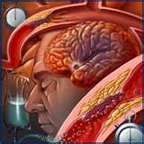 Human Brain - A stroke is the rapidly developing loss of brain functions due to a disturbance in the blood supply to the brain. This can be due to ischemia (lack of blood supply) caused by thrombosis or embolism or due to a hemorrhage. As a result, the affected area of the brain is unable to function, leading to inability to move one or more limbs on one side of the body, inability to understand or formulate speech or inability to see one side of the visual field. [1] In the past, stroke was referred to as cerebrovascular accident or CVA, but 

