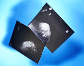 Mammogram - Mammograms Showing a Healthy and Cancerous Breast