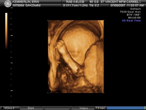 3-D Ultrasound - 3-D ultrasound photo of unborn baby, with arm in front of face.
