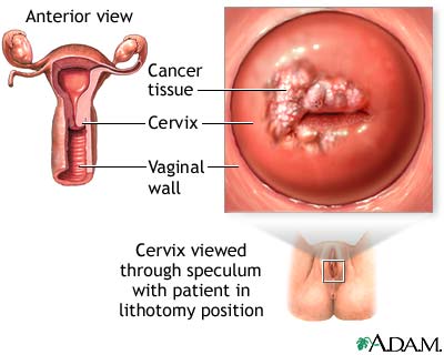 Cancer - Cancer of the Cervix and ovary