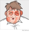 allergy - swollen face allergy - swollen face