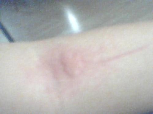 Big mosquito - My arm got biten and it is a big spot!