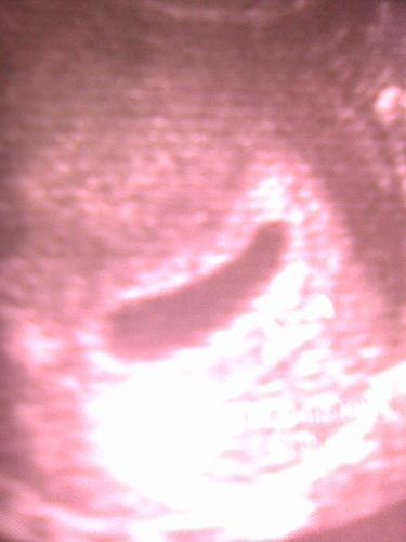 gestational sac - The first sign of pregnancy in the ultrasound