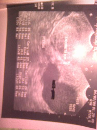 Endometriosis - The eight looking figure is how endometriosis look like on ultrasound.It causes dysmenorrhea