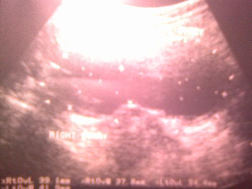 A picture of endometriosis in the ultrasound - This is how endometrioma is seen in ultrasound