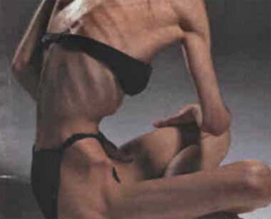 Anorexia Eating Disorder 1 - Stop Eating Disorder Now