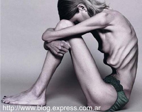 Anorexia Eating Disorder 3 - Anorexia Eating Disorder,Stop it