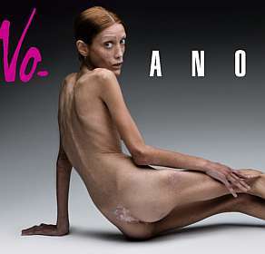 Body to die fo?! Anorexia Eating Disorder - Would u like your body to look like this?