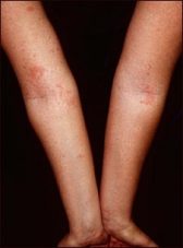 Skin Allergy - Itchy skin and rashes