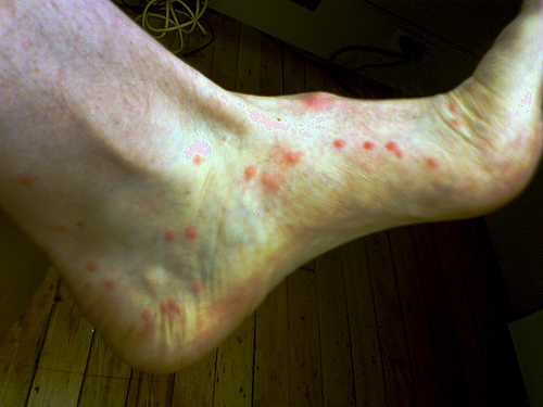 help!!(t_t) - Flee bite photo.  Mine are smaller and covers both of my legs and feet, plus some spots on my arms.(T_T)