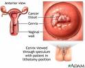facts of cervical cancer - Cervical cancer