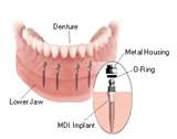 Mini Implants - This is what I'm getting in August. I'll be paying for them for the rest of my life but at least I'll be able to eat and not have to worry about my dentures flying out of my mouth!