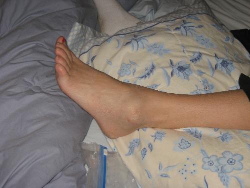 picture of my foot when I hurt it - ankle injury Broken foot