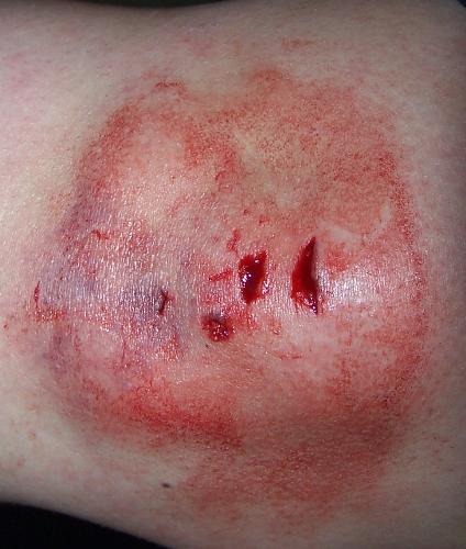 Busted Knee - This is a picture of my knee right after I fell. Pretty, huh? lol