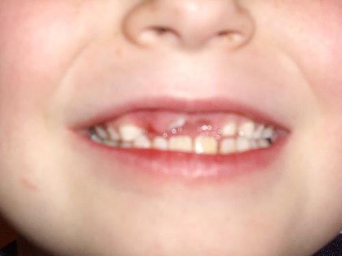 teeth - This is a zoomed in picture of my step brothers teeth, it was soo cute how he couldnt wait to get money from the tooth fairy, I love him a lot and hope his teeth grow in straight, because braces stink.