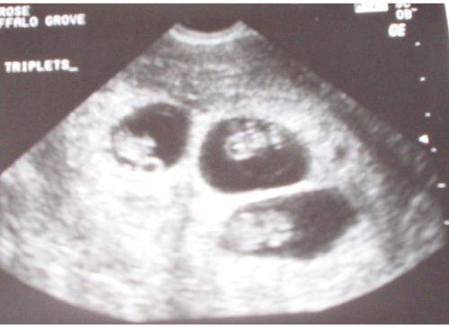 Triplets, ultrasound - ultrasound of triplets bbg