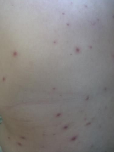 chicken pox - A picture of chicken pox blisters located at the back of the body