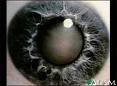 Eye Cataract - This is a sample of what Cataracts looks like - please look through my other photo's to see some more examples of what cataracts can look like if things go wrong.