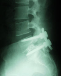 Fusion Surgery - This is an image of a fusion surgery at lower back level