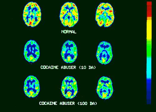 Drug Abuse - This is your brain on drugs. Brain scans of cocaine abusers.