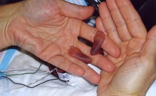 infant - infant leg
