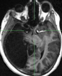 MRI Scan - MRI scan shows girl with only half a brain