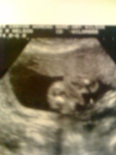 Boy or Girl - Ultra sound photo