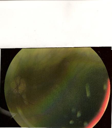 my eyes - picture of one of my eyes w/o dialation. i have optic head disc drusen. i think it is beautiful it looks like a planet.