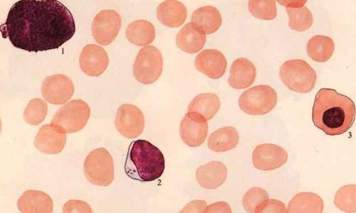 aplastic anemia - the hemogram of aplastic anemia