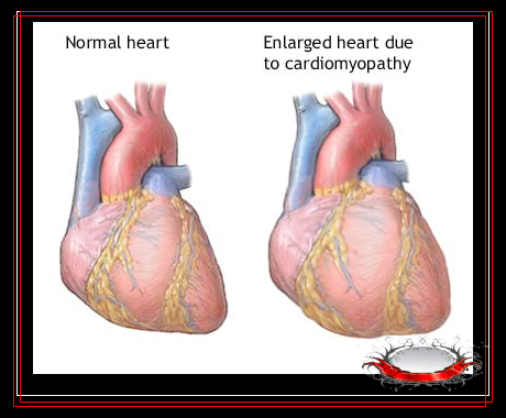 normal and enlarged heart - the left one is a normal,the other is a enlarged heart result from cardiomyopathy