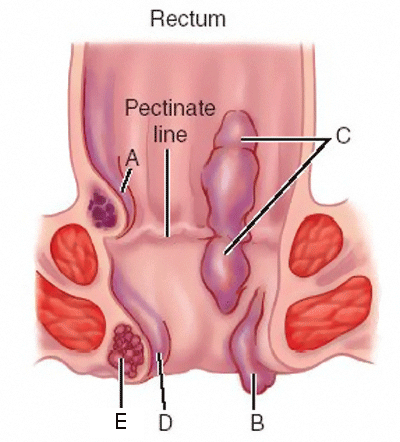 Hemorrhoid - emerods, or piles are swelling and inflammation of veins in the rectum and anus.